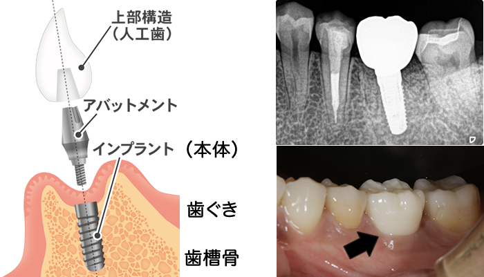 歯科 インプラント トラブル 急増 の 理由