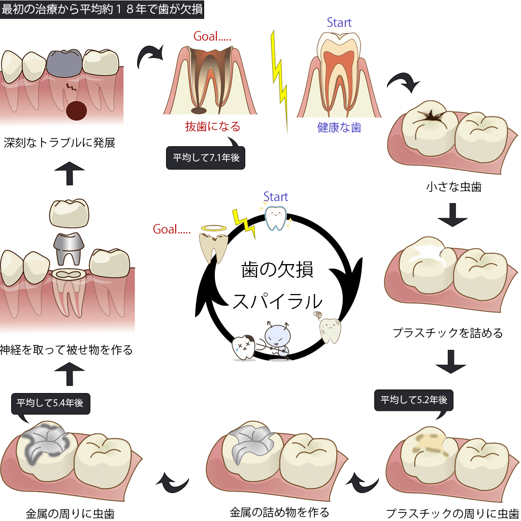 ラバーダムを用いた虫歯治療